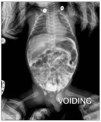 Image result for Voiding Cystourethrogram