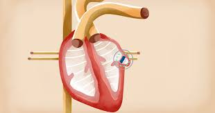 Maybe you would like to learn more about one of these? Watchman Procedure Reduces Stroke Risk In Afib Patients