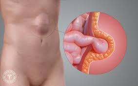 Image result for stomach hernia symptoms
