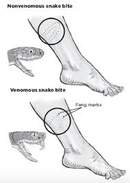Image result for snake bite