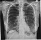 Ginkgo biloba 'jagged jester' is one of the most unique ginkgos i have seen. Ginkgo Leaf Sign Subcutaneous Emphysema Radiology Reference Article Radiopaedia Org