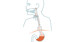 Cerebral hernia ( hernia ce´rebri ) protrusion of brain substance through a defect in the skull. Hiatal Hernia Symptoms And Treatment With Iqoro