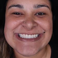 Dr Gabriel Stipe l Estética Dental (@drgabrielstipe) • Instagram photos and  videos