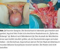 Die fournier'sche gangrän ist ein urologischer notfall, die rechtzeitige diagnose mit sofortigem beginn einer antibiose, intensivtherapie der urosepsis und schneller radikaler exzision der nekrosen kann die prognose deutlich verbessern. Nekrotische Fasziitis