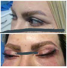 Have you ever wondered how your life would be if you didn't have to take. The Cat Eye Surgery Trend Is Out Of Control Botchedsurgeries