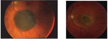 Image result for Choroid