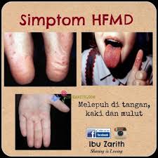 Tidak ada pengobatan khusus untuk penyakit tangan, kaki, dan mulut ini. Rawatan Semulajadi Untuk Penyakit Tangan Kaki Dan Mulut Hfmd Penyakit