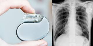 Depending on the type of device, there may be one. Pacemaker And Implantable Defibrillator Ppm Aicd Cardiologist Dr Paul Ong Heart Clinic