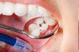What To Do If Your Tooth Broke Off And It S Black Inside Omega Dental Houston Tx