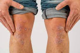 Schuppenflechte Bilder Wir Zeigen Dir Psoriasis In Bildern