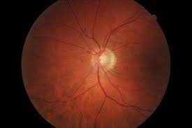 Eye Floaters Facial Therapy Eye Care Eye Floaters Treatment