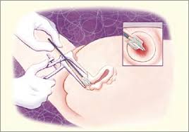 If you're a woman between the ages of 21 and 29, get a pap test every three years and only get hpv testing if you get an abnormal pap test result. Cervical Cancer