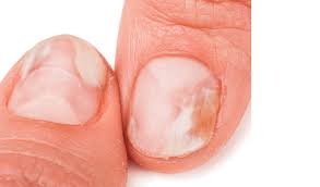 Image result for mykoza nehtů