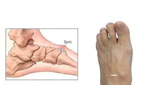Bone spurs (especially on the foot) come about as a result of excessive pressure, stress, or rubbing of the area over prolonged periods. Diagnosing Managing Bone Spurs Country Foot Care