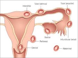 Saat sedang mengalami haid, tubuh wanita. Pendarahan Implantasi Normal Atau Tidak Kedai Vitamin Butterworth