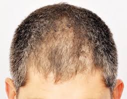 Quali sono le cause della perdita dei capelli? Perdita Capelli Alopecia Cicatriziale E Non Cicatriziale Come Riconoscerla