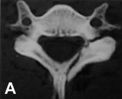 Ct scan is better at defining the fracture. Cervical Lateral Mass Fracture Separation Spine Orthobullets