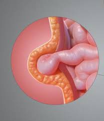 Hernia atau dikenali sebagai angin pasang, uluran dan medu adalah penyakit dimana organ pesakit akan mengalami suatu benjolan tidak normal di bahagian 2. Hernia Pusat Pada Wanita Gejala Dan Rawatan Bagaimana Untuk Menyembuhkan Hernia Pusat Di Kalangan Wanita Tanpa Pembedahan