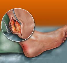 If it is acute, the main aim is to prevent the injury. Current Concepts In Treating Achilles Tendinopathy Podiatry Today