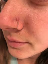 Angry Nose Piercing Been Pierced For Two Months The Piercer Told Me If I Got A Bump That I Should Put Betadine On It For 4 Nights Hasn T Made A Difference I M