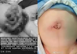 Will my baby's belly button always stick out? Baby S Intestines Pushed Out Of Belly Button After Parents Make Incision To Let The Air Out China News Asiaone