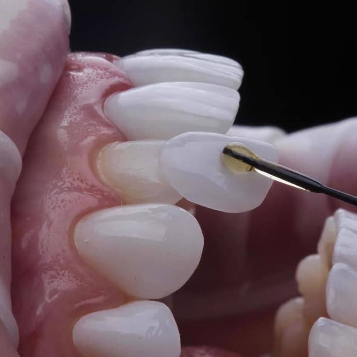 Dental Veneers product image