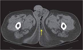 Joint trust clinical procedure for managing fournier's gangrene v1.1; 27 62 Year Old Male Presented With Scrotal Pain Radiology Key