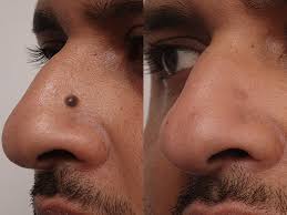 Can I Have a Mole Removed Without Scarring? - The DOC Cosmetic & Skin Clinic