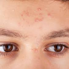 Image result for acne face