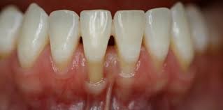 The Danger Of Receding Gums Lane Ends Dental Practice In Lancashire