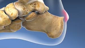 Read more about minimally invasive. Minimally Invasive Achilles Haglund S Syndrome And Endoscopic Calcaneoplasty Orthovirginia