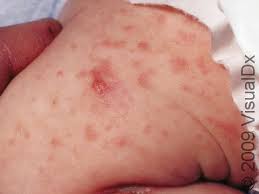 Image result for scabies symptoms