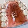 What to do about a palate expander? 1