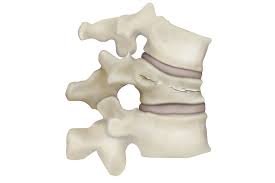 Image result for Vertebral Compression Fracture