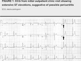 Image result for Early Repolarization