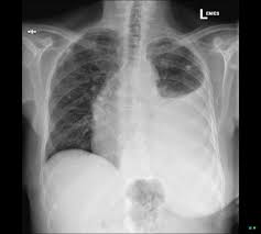 My pleural effusion healed without treatment. Pleural Effusion Radiology Reference Article Radiopaedia Org