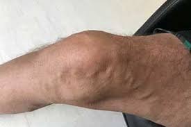 Beinschmerzen Symtom Anzeichen Ursachen Diagnose Behandlung ª Krank De