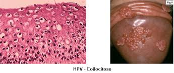 É o vírus do papiloma humano (ou hpv, da sigla em inglês human papiloma virus). Hpv E Patologia Hpv Online Tudo O Que Voce Precisa Saber Sobre O Hpv