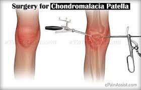 Treatment Surgery Recovery Of Chondromalacia Patella