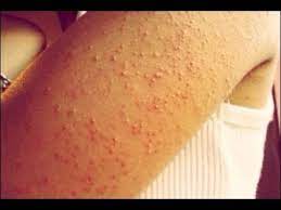 Here are the top 10 home remedies to get rid of bumps on your arms. How To Get Rid Of Bumps On Arms Youtube