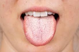 Image result for Oral thrush roof of mouth