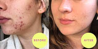 How long can you expect to be dealing with these effects as your hormone levels even out? How Seed Cycling Fixed My Hormonal Acne And Cystic Breakouts
