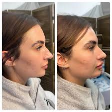 🤌🏼 Filler for Contouring Cheeks, Defining Jawline, and Filling Butt Chin!  Plus a sprinkle in the lips 💋