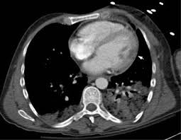 A repeated ct scan (d522) showed nodular changes in pericardium raising the suspicion of a malignancy, or alternatively pericardial tuberculosis. Incidental Cardiac Findings On Thoracic Imaging Sciencedirect