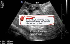 Ibu yang mengalami hamil di luar kandungan bisa disebabkan karena ibu memang memiliki riwayat yang sama dalam keluarga. Tak Payah Membongak Dakwa Bidan Boleh Masukkan Kembali Kandungan Luar Rahim Ini Respon Jururawat