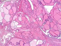 Image result for Multinodular Goiter