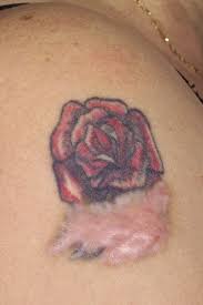 Want more information on how we prevent scarring from tattoo removal? Hypertrophic Scar From Tattoo Dispersion Gel Journal Of Plastic Reconstructive Aesthetic Surgery