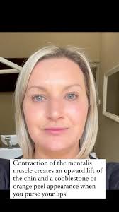 Do you hate that orange peel chin when you purse your lips? See here how  easy it is to get rid of!!! #glasgowaesthetics #aesthetics #chintreatment  #orangepeelchin #facialaesthetics #mentalismuscle ...