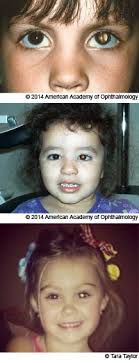 An animated video shows the likelihood of different eye colours for a child based on their they got two kids with brown eyes, one with blue and one with green. Photos Can Help Diagnose Children S Eye Problems And Save Sight American Academy Of Ophthalmology