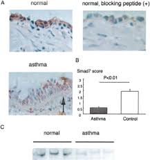 Subepithelial reticular basement membrane (rbm) thickness was variable, but overall was increased in asthmatic patients compared with controls (p<0.01). Expression Of Smad7 In Bronchial Epithelial Cells Is Inversely Correlated To Basement Membrane Thickness And Airway Hyperresponsiveness In Patients With Asthma Journal Of Allergy And Clinical Immunology